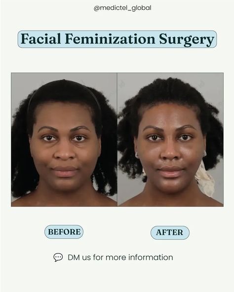 More info about her Facial Feminization Surgery in Korea ⤵️ Here are the procedures she underwent: ✅️ Square Jaw Surgery ✅️ Cheekbone Reduction ✅️ Rhinoplasty ✅️ V3 Lift Ready to start your transformation journey in Seoul? 💌 DM us or comment "transformation" for a free consultation. 👉 We connect you with top clinics and qualified plastic surgeons in Korea! • • • • #squarejaw #cheekbonereduction #rhinoplasty #rhinoplastykorea #faciallifting #plasticsurgerykorea #plasticsurgeryinkorea  ... Reduction Rhinoplasty, Cheekbone Reduction, Square Jaw, Plastic Surgery Korea, Jaw Surgery, Beauty Procedures, Facial Contouring, Anti Aging Body, Nose Surgery