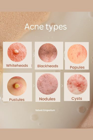 ACNE TYPES Acne Types And Causes, Face Acne Remedies, Papules Acne, Pustules Acne, Acne Aesthetic, Acne Types, Closed Comedones, Inflammatory Acne, Cause Of Acne