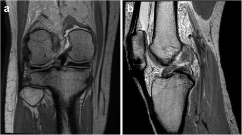 Journal. PLOS.org  Comparison of medial & lateral tears of meniscus Medial Meniscus, Anterior Cruciate Ligament, Ligament Tear, Acl Tear, Cruciate Ligament, Magnetic Resonance Imaging, Magnetic Resonance