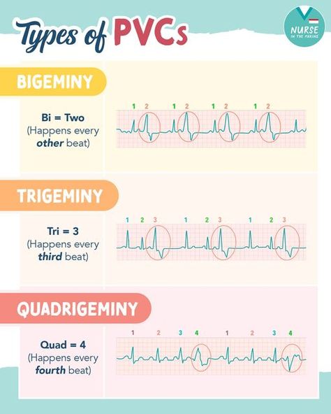 Ekg Rhythms Cheat Sheets, Cardiac Rhythms Cheat Sheets, Telemetry Technician, Ekg Tech, Ekg Rhythms, Ekg Technician, Nclex Practice Questions, Nurse In The Making, Nurse Skills