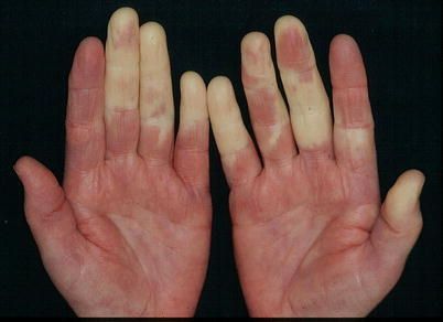 Raynaud Syndrome With Pallor - MManual Reynauds Syndrome, Angina Pectoris, Cardiovascular Disorders, Salivary Gland, Connective Tissue, Lung Disease, Shortness Of Breath, Autoimmune Disease, Migraine