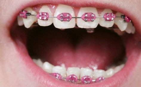 Think what color braces should I get? There are many options available for braces colors, if you want to hide your braces Invisalign is best choice. Get best braces color options for guys. Hot Pink Braces Teeth, Braces Hot Pink, Hot Pink Braces, Braces Journey, Braces Colours, Tracy Ross, Braces Color Wheel, Braces Ideas, Pink Braces