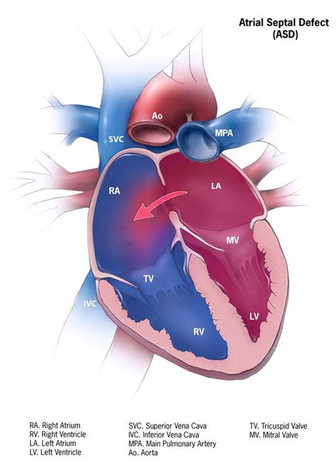 Hole In Heart, Cardiac Ultrasound, Bicuspid Aortic Valve, Atrial Septal Defect, Cardiac Sonography, Nicu Nursing, Cardiothoracic Surgery, Chd Awareness, Heart Anatomy