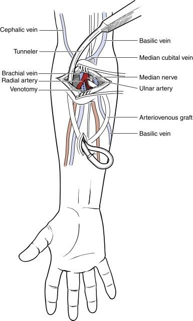 Forearm Loop Graft and Brachial Artery–Axillary Vein Interposition Graft | Thoracic Key Axillary Artery, Brachial Artery, Median Nerve, Magnetic Resonance, Historical Background, Medical History, Healthcare System, Disease, 1970s