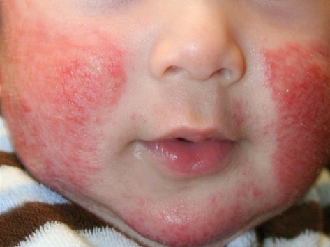 contact dermatitis pictures Types Of Skin Rashes, Kids Allergies, Healthy Wealthy, Skin Allergies, Fundraising Events, Feel Pretty, Dermatology, Baby Ideas, Medical Conditions