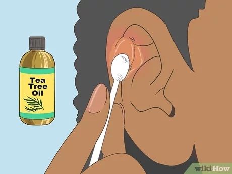 3 Ways to Heal Cartilage Piercing Bumps - wikiHow Cartilage Piercing Infection, Infected Ear Piercing, Tea Tree Cream, Piercing Bump, Ways To Heal, New Piercing, Healing Essential Oils, Healing Ointment, Oil Remedies