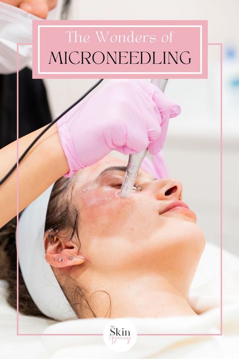 Discover the wonders of microneedling and unlock the secret to radiant skin! Experience the amazing microneedling benefits that leave your skin looking flawless with remarkable microneedling results. See the transformation in captivating microneedling before and after pictures. Don't forget the essential microneedling after care for long-lasting, glowing skin. Say hello to a new era of skincare with microneedling! Microneedling Video, Microneedling After Care, Microneedling Before And After, Microneedling Benefits, Esthetician Aesthetic, After Care, After Pictures, Before And After Pictures, Skin Care Treatments