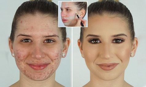 Make up artist covers acne using foundation and GREEN concealer #DailyMail Green Concealer How To Use, How To Use Green Concealer, Cover Up Acne With Makeup, Best Makeup For Acne, Acne Cover Up, Covering Acne, Green Concealer, Primer For Dry Skin, Acne Scaring