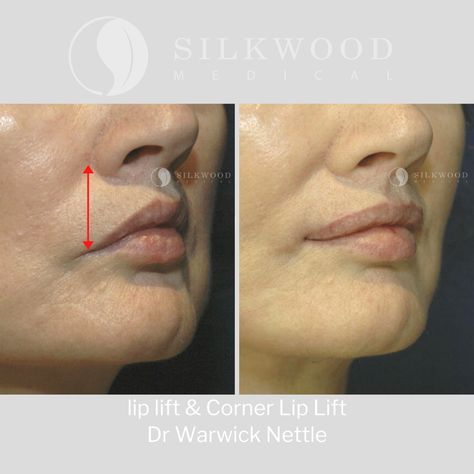 Lip lift surgery exposes more of your top lip making it appear fuller.  Corner lip lift surgery is suitable for clients with a down turned top lip. The incisions for corner lip lift are on the top lip line. As you can see in the before image the corner of her lip has been significantly lifted.  Contact our team to find out more.⁠ ⁠ E: reception@silkwoodmedical.com.au⁠ ⁠ #lipliftsurgery #upperlipliftsurgery #modifiedlipliftsurgery #bullhornliplift #cornerliplift Lip Lift Surgery, Acne On Nose, Eye Lift Surgery, Affirmation Lockscreen, Body Contouring Surgery, Lip Surgery, Lip Lift, Lips Inspiration, Aesthetic Dermatology