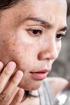 Hyperpigmentation can be extremely difficult to treat. In this post we discuss how combining Hydroquinone and Tretinoin can offer a potent solution to safely and effectively fade dark spots and even out skin tone.  ... less Pigmented Skin, Dark Spots On Face, Serious Skin Care, Acne Skincare Routine, Dark Spots On Skin, Remove Dark Circles, Skin Spots, Spots On Face, Clear Skin Tips