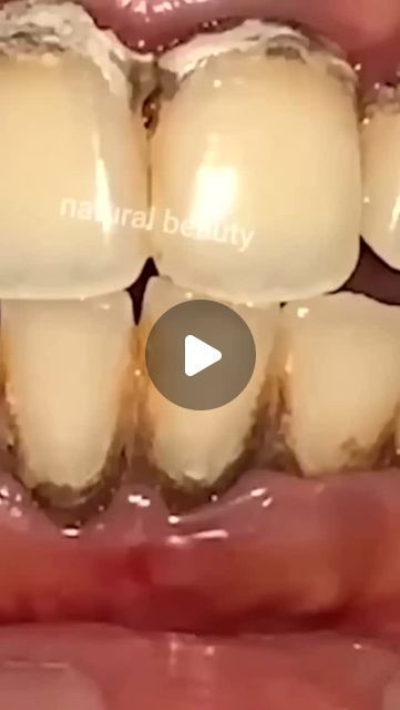 Healthy Tips on Instagram: "Remove Tartar and Yellowness From Your Teeth #teethwhitening #yellowteeth #remedy #naturalremedies" How To Use Coconut Oil For Teeth, How To Remove Tartar From Teeth, Teeth Sensitivity Remedies, Remove Tartar From Teeth At Home, Yellow Teeth Remedy, Tooth Powder Recipe, Milia Removal, Turmeric Teeth Whitening, Tooth Health