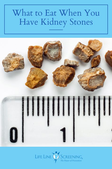 Kidney stones can be a painful experience. Incorporating the right items to your diet can help make the process easier in getting rid of them. Read on to find out what can help. Kidney Stone Remedies, Kidney Stone Pain Relief, Kidney Symptoms, Kidney Stone Diet, Kidney Healthy Foods, Turmeric Uses, Salt Substitute, Fruit Recipes Healthy, Kidney Detox