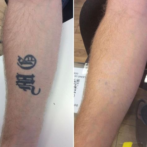 Laser tattoo Removal Clinic near me. Complete Tattoo, Laser Tattoo, Laser Tattoo Removal, Tattoo Removal, After Photos, Ink Color, Dark Black, Beauty Health, Tattoo Quotes