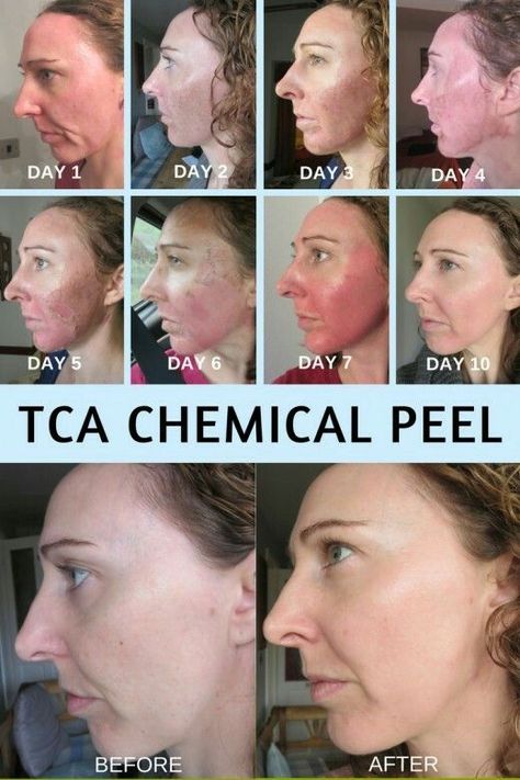 Natural Aging Skin Care, Skin Peeling On Face, Chemical Peel At Home, Face Peel, Facial Peel, Peeling Skin, Chemical Peel, Acne Skin, Anti Aging Skin Products