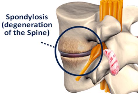 Low Back Pain Due to Lumbar Spondylosis, Degenerative Joint Disease affecting Lower Lumbar Vertebrae, Disc, And Related Nerve Root. Spinal Anatomy, Lumbar Spondylosis, Lumbar Vertebrae, Spinal Degeneration, Lumbar Lordosis, Hamstring Muscles, Cervical Spondylosis, Chronic Lower Back Pain, Muscle Stretches