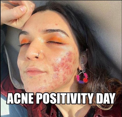 Acne Self Love, Normalize Acne, Acne Positive, Acne Is Beautiful, Strawberry Freckles, Pimple Under The Skin, Acne Aesthetic, Acne Women, Acne Positivity