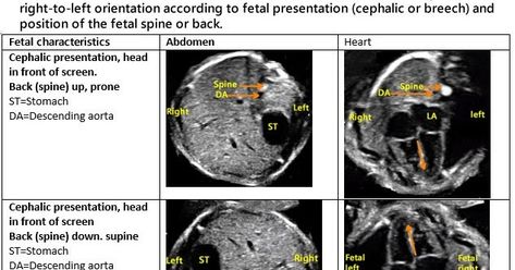 How To Determine Fetal Presentation and Fetal Situs Ultrasound - YouTube Fetal Presentation, Ultrasound, Assessment, Presentation