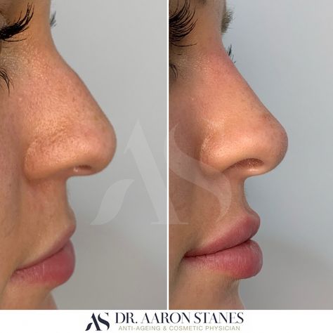 Natural Side Profile, Nose Job Inspiration Side Profile, Lip Fillers Side Profile, Side Profile Before And After, Natural Nose Job Before After, Nose Job Natural, Lip Filler Side Profile, Noses Side Profile, Nose Inspiration Rhinoplasty