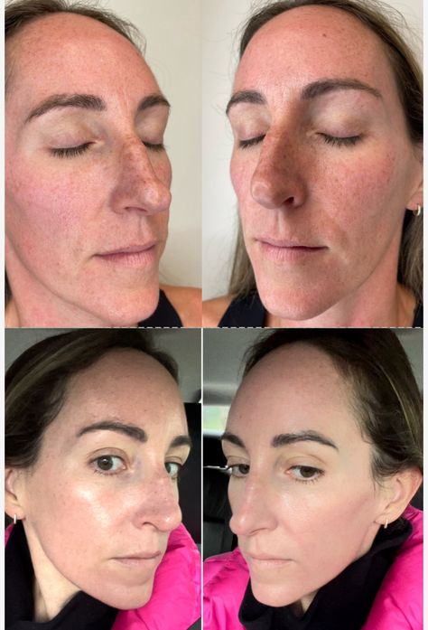 My Experience Getting CoolPeel CO2 Laser For Sun Damage Laser Genesis Before And After, Coolpeel Laser, Fractional Laser Before After, Erbium Laser Resurfacing, Fraxel Laser Before And After, Co 2 Fractional Laser, Numbing Cream, Tanning Bed, Laser Skin