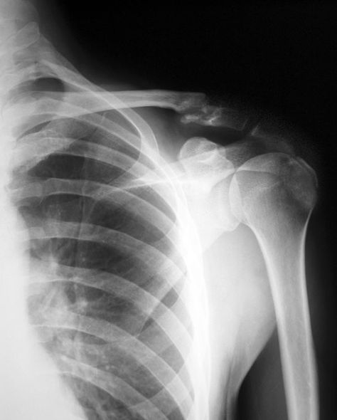 Left Shoulder Xray - Fx Clavicle Shoulder Xray, Injury Aesthetic, Medical Artwork, Broken Ribs, Bone Fracture, Broken Arm, Knee Exercises, Shoulder Injuries, Collar Bone