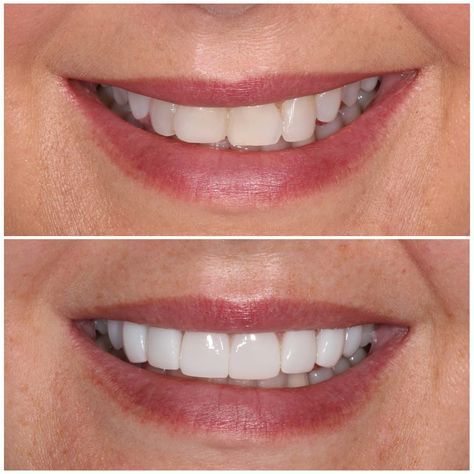 Cosmetic dentistry techniques like dental bonding before and after can fix chips, cracks, stains, and other imperfections in your teeth. Dental Bonding Before And After, Teeth Bonding Before And After, Teeth Bonding, Composite Bonding, Dental Composite, Ski Mask The Slump, Composite Veneers, Dental Bonding, Slump God