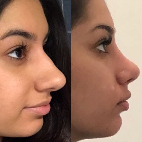 Bulbous Tip Rhinoplasty Before After, Rhinoplasty Bulbous Tip, Bulbous Tip Rhinoplasty, Tip Rhinoplasty, Nose Ideas, Kpop Plastic Surgery, Jaw Reduction Surgery, Nose Surgery Rhinoplasty, V Line Surgery