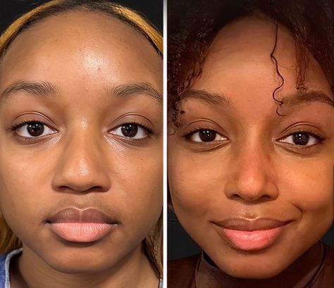 The Cosmetic Lane on X: "Rhinoplasty 👃🏾✨ The idea of an ethnic rhinoplasty is to preserve as much ethnicity as possible while attempting to address concerns patients have with their noses. https://t.co/eeaVvzxVz8" / X Bulbous Nose Rhinoplasty Before After, Wide Nose Rhinoplasty, Ethnic Nose Job, Bad Nose Jobs, Nose Rhinoplasty, Jaw Reduction Surgery, Surgery Aesthetic, Ethnic Rhinoplasty, Eyebrow Transplant