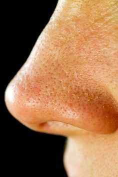 Solutions For Large Pores - What Causes Pores to Enlarge? To Remove Blackheads, Remove Blackheads, Get Rid Of Blackheads, Beauty Remedies, Large Pores, Homemade Face, Beauty Recipe, Homemade Beauty Products, Blackhead Remover