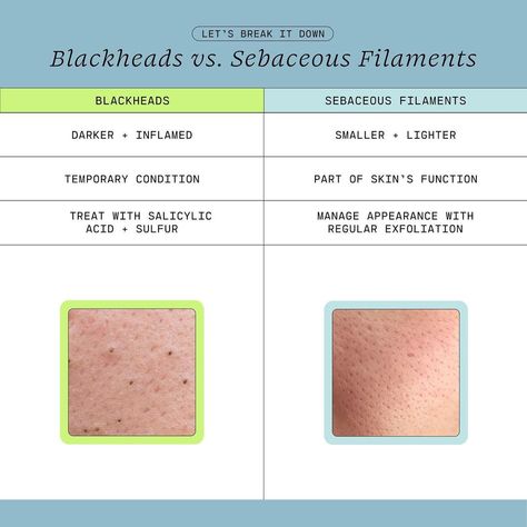 Sebaceous Filaments Vs Blackheads, Sebaceous Filaments, Pimple Cream, Skin Advice, Pore Strips, Types Of Acne, Aesthetic Medicine, Be The Reason, Clear Skin Tips