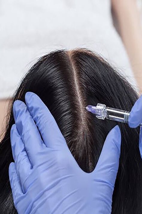 PRP / PRF - Hair Regeneration ✚ Hair Growth Cycles & treatments ✚ Why Do You have Hair Loss? ✚ PRF/P Hair Regenerate Therapy ✚ Advantages of PRF Hair Regeneration ✚ Dual PRP & PRF Method ✚ Complications: ✚ Injection Techniques ✚ Classification & Patterns of Hair Loss: #prp #prf #vidaskinbeautycenter #prphairgrowth #skincare #skincareroutine #agelessbyabovian #hairgrowth #beauty #hairloss #hair Platelet Rich Plasma Therapy, Prp Hair, Androgenetic Alopecia, Lifting Facial, Platelet Rich Plasma, Hair Thinning, Regrow Hair, Aesthetic Clinic, Scalp Conditions