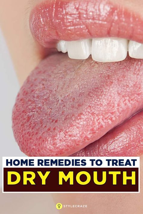 Remedies For Dry Mouth, Snoring Remedies, Tongue Health, Dry Mouth, Cold Sores Remedies, Different Diets, Natural Sleep Remedies, Natural Cold Remedies, Natural Cough Remedies