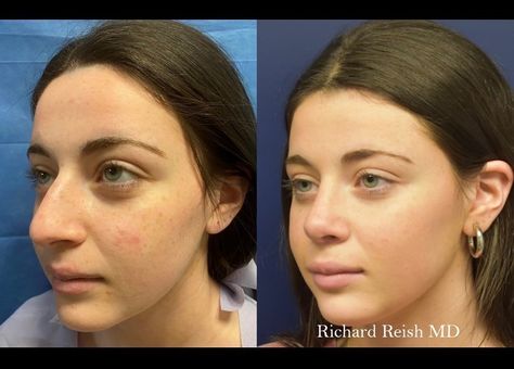 Rhinoplasty Bulbous Tip, Turkey Rhinoplasty, Bulbous Nose Rhinoplasty Before After, Bulbous Nose Rhinoplasty, Jaw Reduction Surgery, Bulbous Nose, Plastic Surgery Fail, Rhinoplasty Nose Jobs, Plastic Surgery Photos