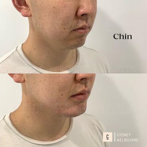 CHIN AUGMENTATION

Enhance the appearance of your chin with a non-surgical chin augmentation. This alternative to chin implant surgery addresses small, recessed chins, and combats signs of chin ageing.

#cosmeticconnection #draaronstanes #cosmeticdoctor #sydneyclinic #chin #chinaugmemtation #chinenhancement Neck Lift Surgery, Double Chin Reduction, Chin Augmentation, Chin Implant, Nose Reshaping, Anti Wrinkle Injections, Cosmetic Injectables, Excessive Sweating, Cosmetic Treatments