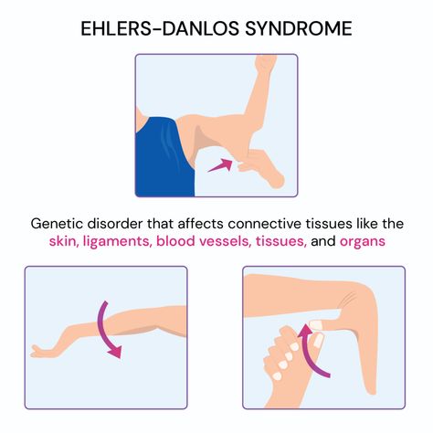 23 Signs You Grew Up With Ehlers-Danlos Syndrome Elders Danlos Syndrome, Ehlers Danlos Syndrome Diet, Elhers Danlos Syndrome Hypermobility, Hypermobile Ehlers Danlos Syndrome, Eds Ehlers Danlos Syndrome, Ehlers Danlos Syndrome Types, Ehlers Danlos Syndrome Symptoms, Hypermobile Joints, Elhers Danlos Syndrome