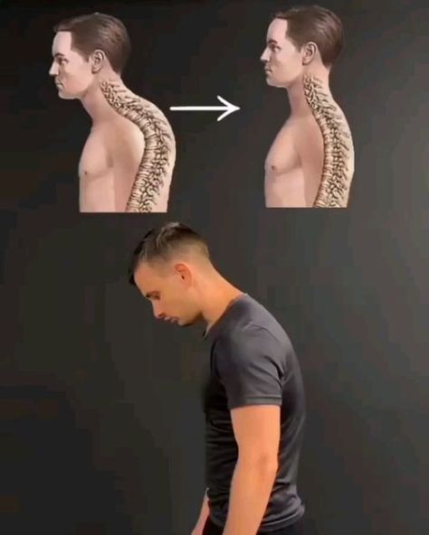 Neck Hump, Workout Back, Mobility Training, Bolesti Chrbta, Fix Your Posture, Correct Posture, Posture Exercises, Abs Workout Gym, Fitness Pilates