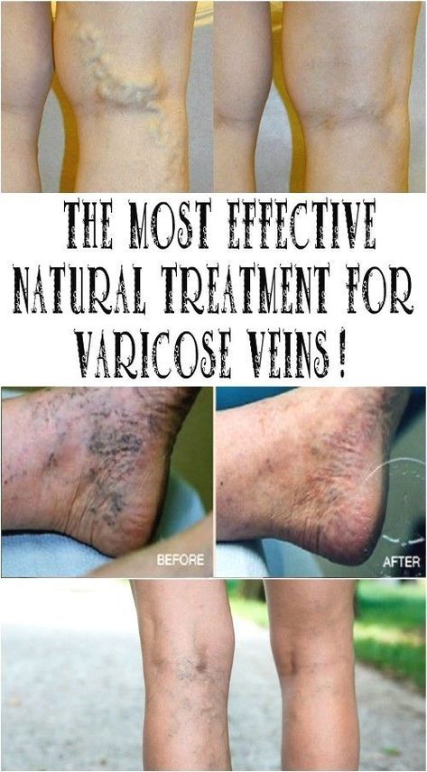 How To Get Rid Of Varicose Veins Naturall Varicose Vein Remedy, Home Medicine, Health Tips For Women, Health Info, Health Advice, Natural Treatments, Natural Medicine, Health Remedies, Herbal Remedies