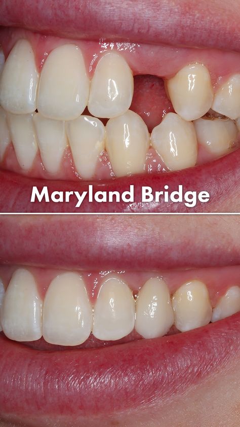 Tooth Bridge, Natural Wrinkle Remedies, Dental Decay, Wrinkle Remedies, Dental Bridge, Teeth Implants, Tongue Health, Smile Teeth, Galway