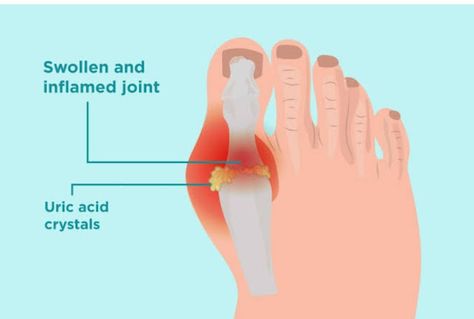 Educatrix: URIC _ACID Purine Diet, Kwas Moczowy, Uric Acid Crystals, Uric Acid Levels, Lipid Profile, Urdu Stories, Body Joints, Uric Acid, Medication Management