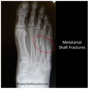 Metatarsal Shaft Fractures | footEducation Broken Foot Humor, Broken Bones Humor, Femur Fracture, Patella Fracture, Open Fracture, Metatarsal Fracture, Tibial Plateau Fracture, Fracture Healing, Types Of Fractures