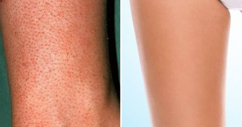 Strawberry Skin Remedies, Strawberry Arms, Getting Rid Of Strawberry Legs Tips, How To Get Rid Of Strawberry Legs Fast Homemade, How To Avoid Strawberry Skin, How To Treat Strawberry Legs At Home, Rid Of Strawberry Legs Beauty Tips, How To Get Rid Of Strawberry Legs Fast, Mermay 2024