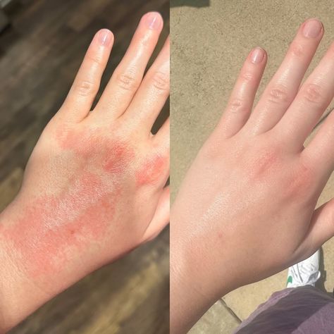 Today starts National Eczema Week so I thought I’d shine a little spotlight on this overnight transformation! I have battled with eczema since I was a baby & the relief is not always this speedy… There have been many times where I cannot open my hands fully, or my skin cracks open when I hold a pen, & constantly being asked “did you get in a fight?” because of the inflammation & sores on my knuckles. I went YEARS before discovering my skin wasn’t ‘just dry’ and that I didn’t need another cre... Road Rash, Burn Mark, Open When, Dermatology, My Skin, Pen, Road, Skin, Tumblr