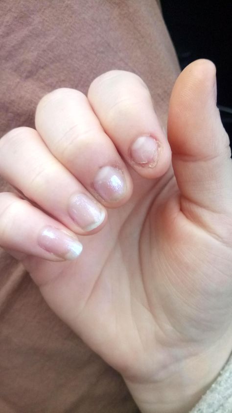 Been biting nails for 15 years slowly getting better and now I can see the four stages of my nails improving on one hand. Biting Nails Aesthetic, Nails For 15, Biting Nails, Nails Aesthetic, Nail Biting, Getting Better, My Nails, The Four, Then And Now