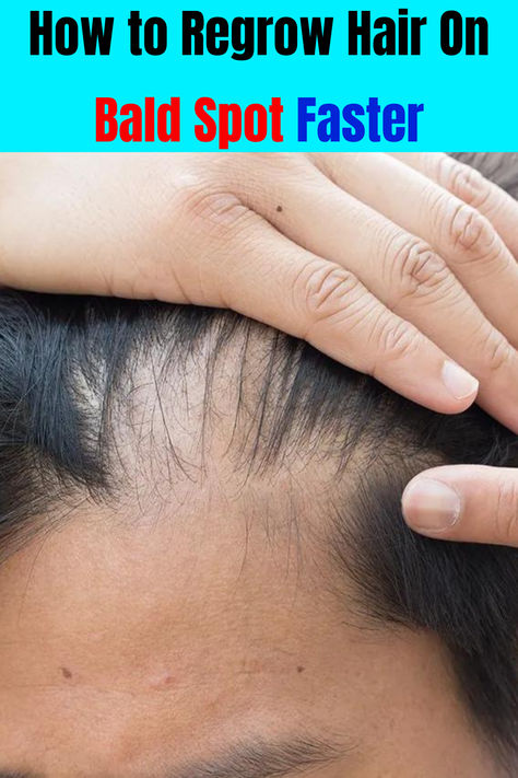 One of the home remedies for hair fall and regrowth includes onion juice which may also help to reduce bald spots... How To Regrow Hair On Bald Spots, How To Regrow Hair, Remedies For Hair Fall, Unwanted Hair Growth, Hair Nutrition, Onion Juice, Bald Patches, Hair Growth Cycle, Hair Business