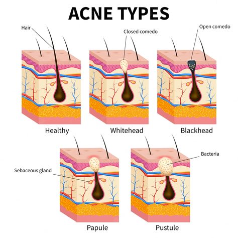 Acne Types, Skin Anatomy, Facial Procedure, Anatomy Medical, Types Of Acne, Skin Structure, Diagram Design, Summer Skin, Skin Diseases