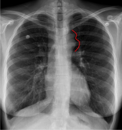 Coarctation of the aorta | Radiology Case | Radiopaedia.org Heart Xray, Aortic Arch, Coarctation Of The Aorta, Subclavian Artery, Radiologic Technologist, Radiology Student, Radiology Imaging, White Rocks, Xray Technician