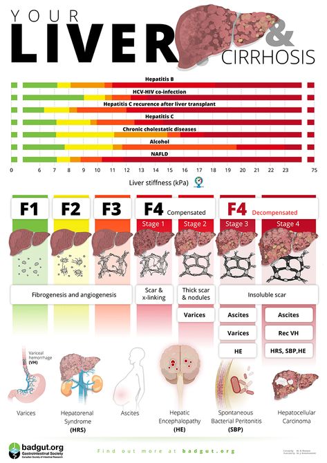 Your Liver & Cirrhosis Poster - Gastrointestinal Society Cirrhotic Liver, Liver Fibrosis, Nursing School Essential, Healthy Liver, Nursing School, Health And Wellbeing, Disease, Medicine, Repair