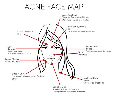 Acne Face Map - What Acne revealing about your Health - Divine Glowing Health Doterra Acne, Gesicht Mapping, Acne Face Map, Face Map, Face Mapping Acne, Body Toxins, Acne Face, Face Mapping, Acne Causes