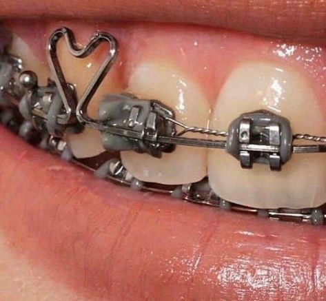 Teeth Aesthetic, Cute Braces Colors, Getting Braces, Braces Girls, Orthodontic Appliances, Cute Braces, Bright Eye Makeup, Brace Face, Braces Colors