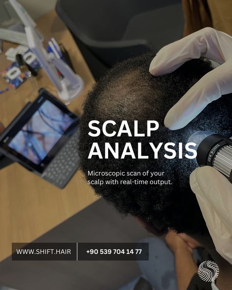 Scalp Analysis: Microscopic scan of your scalp with real-time output Scalp Analysis, Hair Transplant Results, Hair Transplant Surgery, Hair Transplant, Hair Restoration, Afro Hairstyles, Hair Transformation, Hair Care, Hair