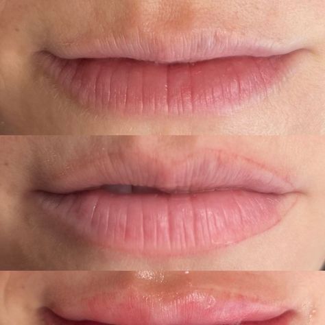 Alyssa • Lip Blush • Microblading • Tiny Tats on Instagram: "Stages of lip blush for those that are interested in the appointment process 💄

- We'll talk about your goals with shape and color and any concerns 
- Take some before pics 
- Mapping the shape 
- Outline the shape 
- Numbing and Shading the passes 
- Clean up and apply healing ointment 
- Take after pics (helps the client and myself see the full results from beginning to end) 
- Go over aftercare and what to expect during the healing process 
- Schedule touchup 6-8 weeks out 
- Leave with beaut lips 

Appointment in total is 2-3 hrs 

Book your vacay lips now so they're healed by summer ☀️ Booking link in bio or DM directly 😊 

PS for those who experience coldsores it is pertinent to get a script and take it before your appoin Tiny Tats, The Healing Process, Lip Blush, Healing Ointment, Cold Sore, A Script, Healing Process, May 7th, Microblading